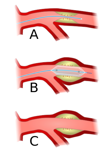Angioplasty