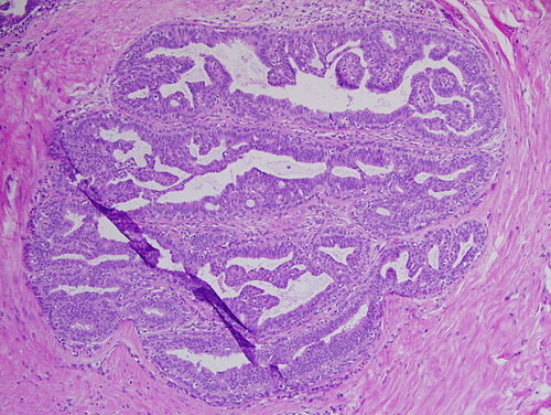 papiloma doctor pleoapa papilloma nasale invertito